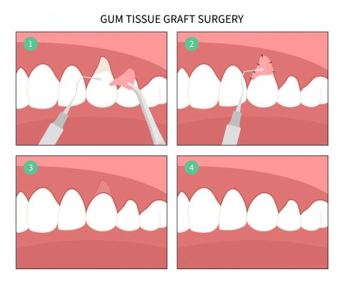 greffes-gingivales